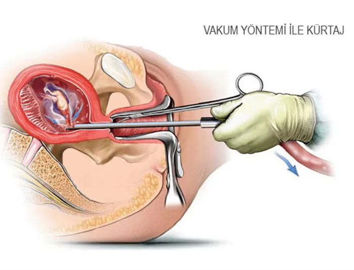 Vakumlu Kürtaj Nedir, Güvenli midir?