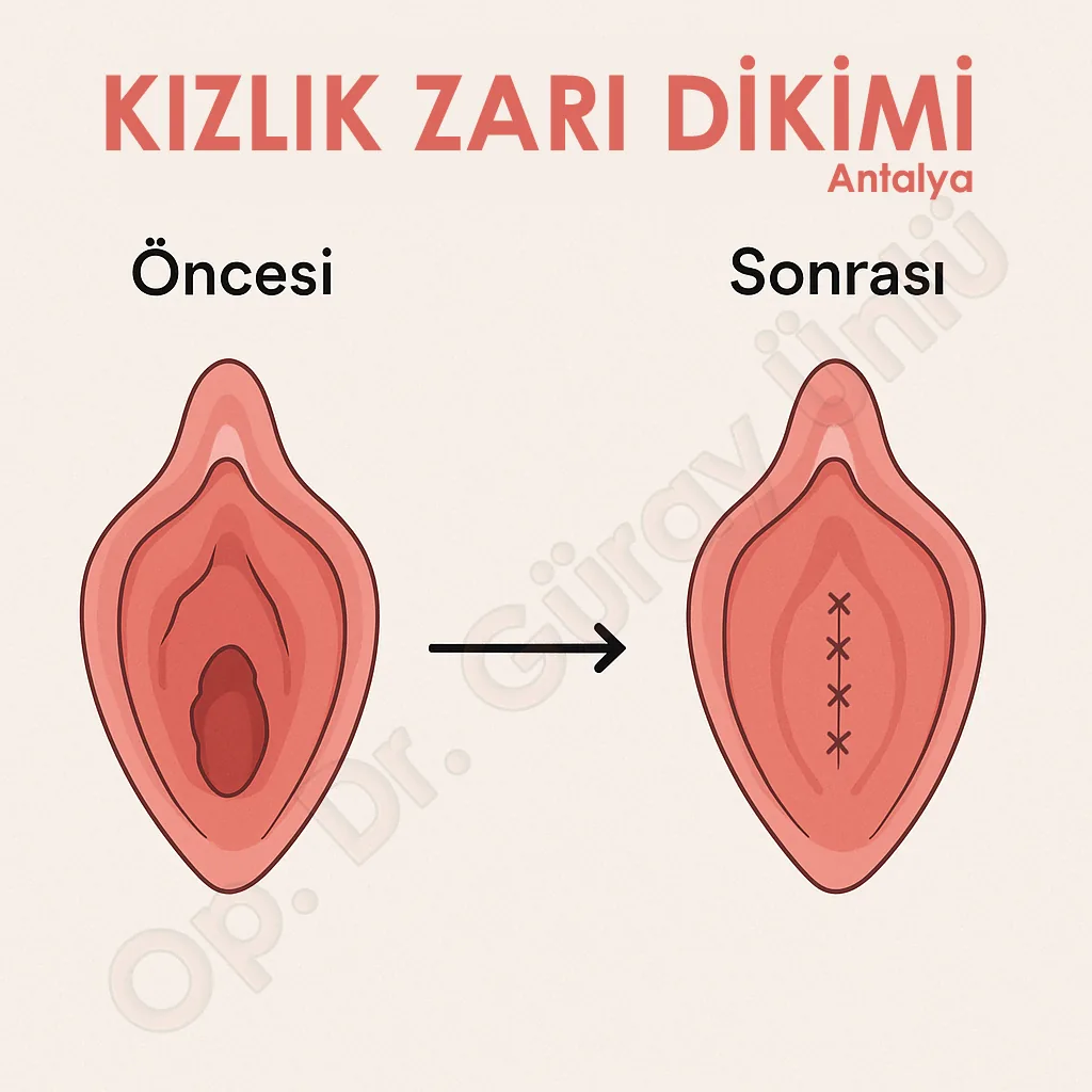 Antalya Kızlık Zarı Dikimi