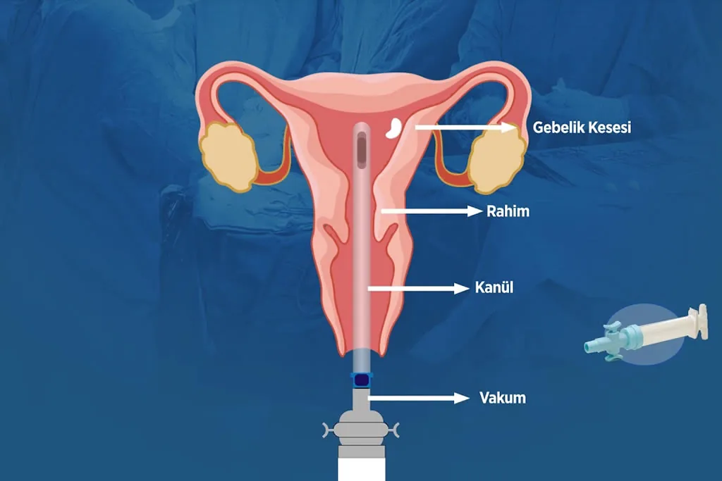 Vakumlu Kürtaj Nedir, Güvenli midir?
